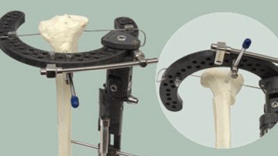 High Tibial Osteotomy Fixtaion System